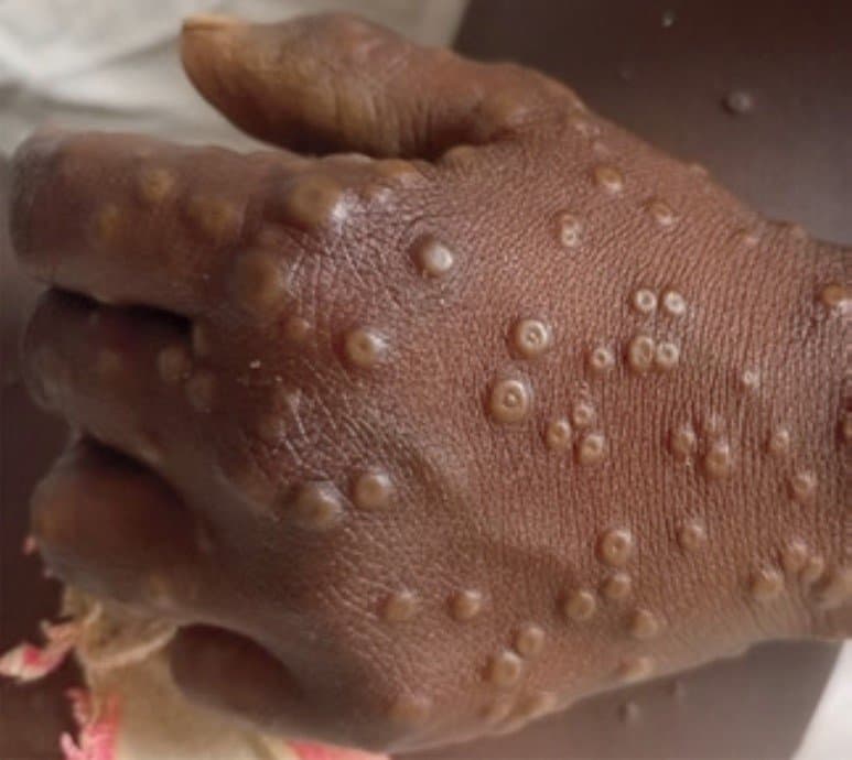 Mpox au Cameroun : les autorités rassurent et renforcent la riposte